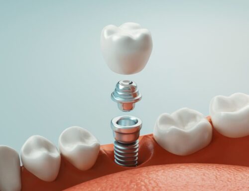 Dental Implants: Your Guide to a Lasting Smile