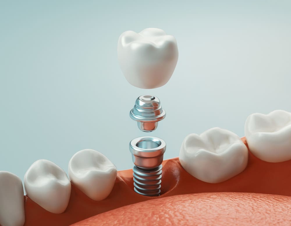 Dental Implants: Your Guide to a Lasting Smile